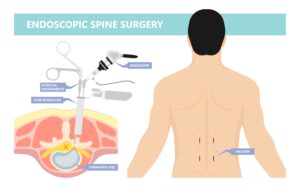 Endoscopic Spine Surgery in Seattle, WA | Edward Jung, MD, MS